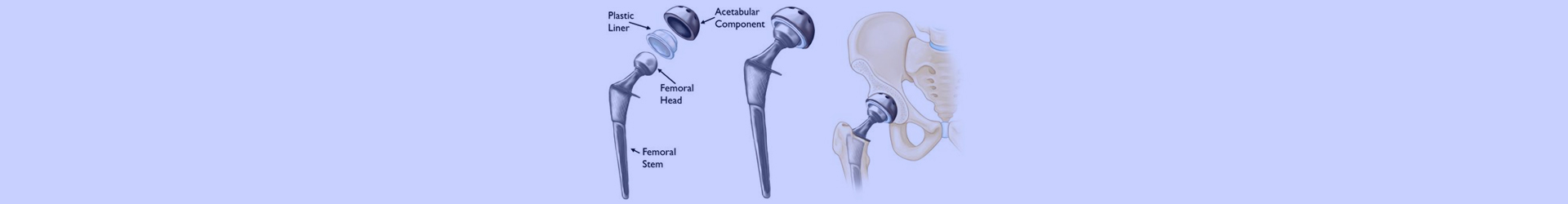 Hemi Hip Replacement in Jamshedpur