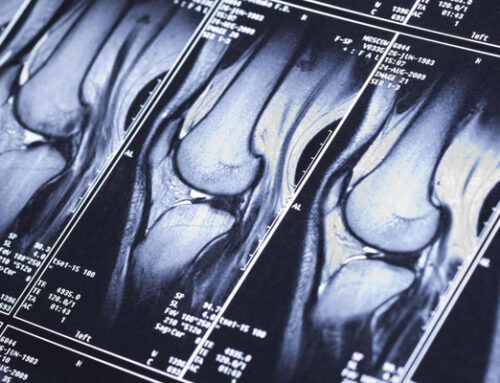 MRI Says “Tear” — Does That Always Mean Surgery? A Clear Decision Guide