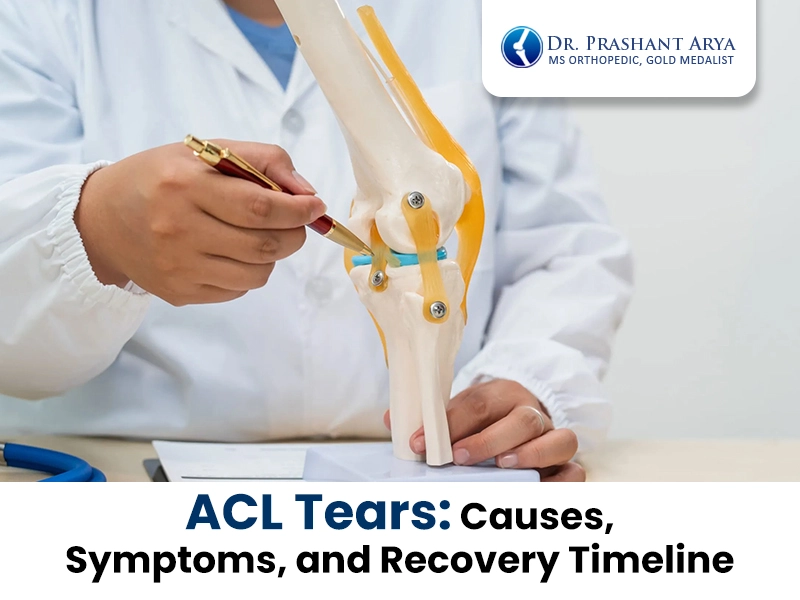 ACL Tears: Causes, Symptoms, and Recovery Timeline