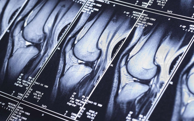 MRI Says “Tear” — Does That Always Mean Surgery? A Clear Decision Guide